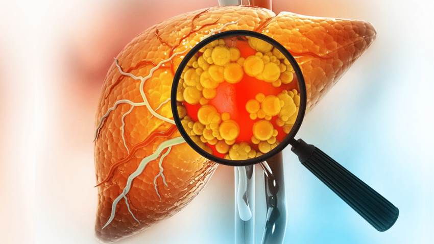 Alto riesgo de daño hepático y cáncer en personas con obesidad o diabetes por ingesta de comidas rápidas