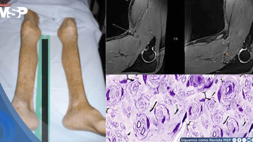 Tras infección respiratoria, paciente presentó dificultad para caminar y pérdida de equilibrio