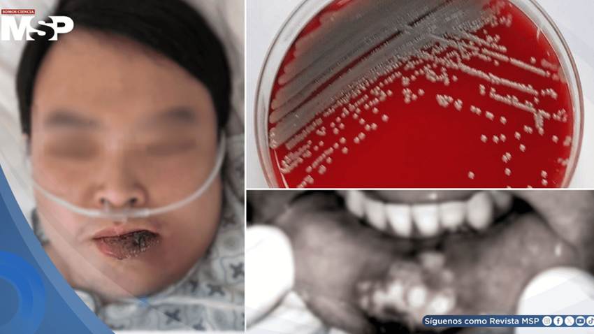Paciente con diabetes no diagnosticada desarrolla infección facial por bacteria resistente y cetoacidosis