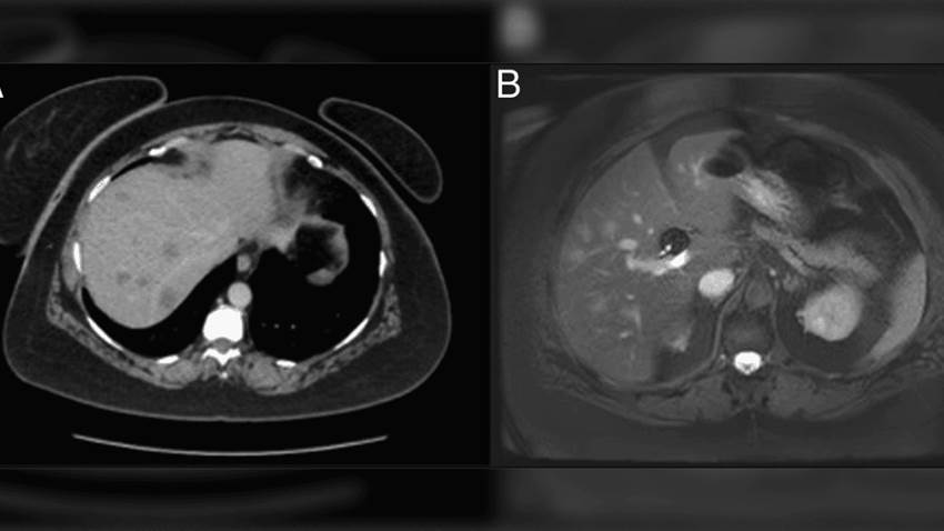 Artritis Reumatoide seronegativa desencadena raro caso de nódulos hepáticos en paciente femenina