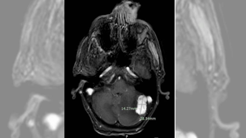 Masa nasal culmina con un diagnóstico de melanoma metastásico