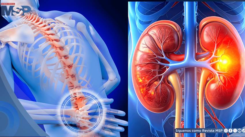 ¿Dolor de espalda o problema renal? Reconoce las señales que alertan sobre una afección en el riñón