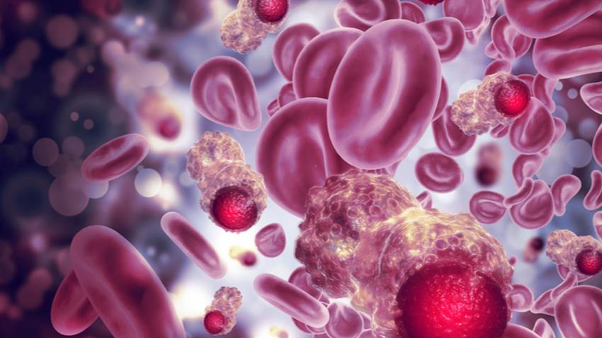 Sintomatología de COVID-19 sería más grave en pacientes con leucemia