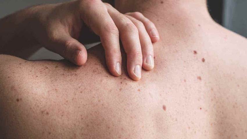 Paciente boricua enfrenta exitosamente diagnóstico de melanoma en etapa tres