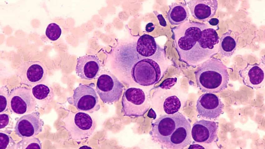 El régimen de tripletes aumenta la supervivencia en el melanoma metastásico