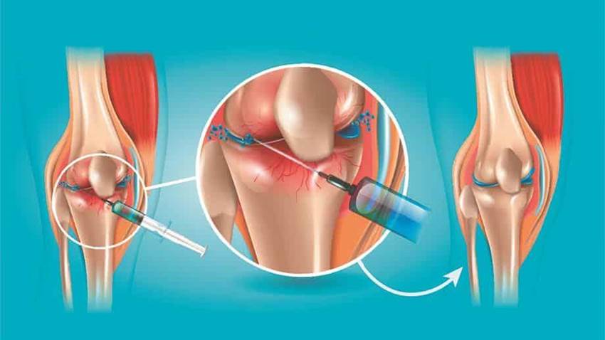 Las inyecciones de plasma rico en plaquetas no muestran ningún beneficio en la artrosis