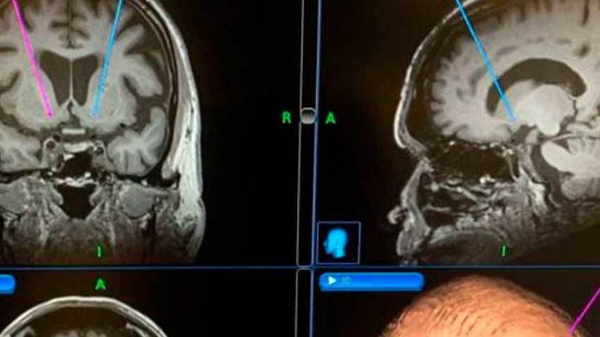 Prueban un implante cerebral para controlar la adicción al alcohol