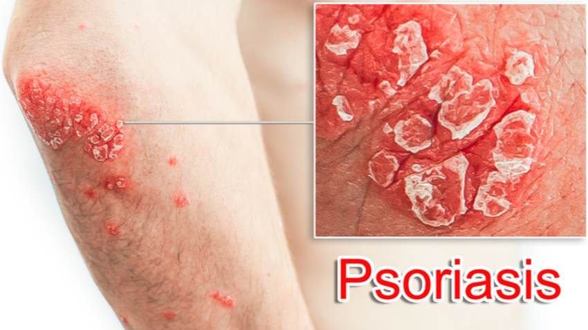 Psoriasis en placa: enfermedad genéticamente predeterminada