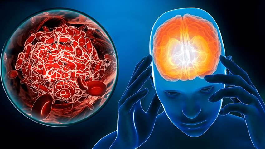 Grasa vegetal se relaciona con menor riesgo de accidente cerebrovascular, frente a grasas animales