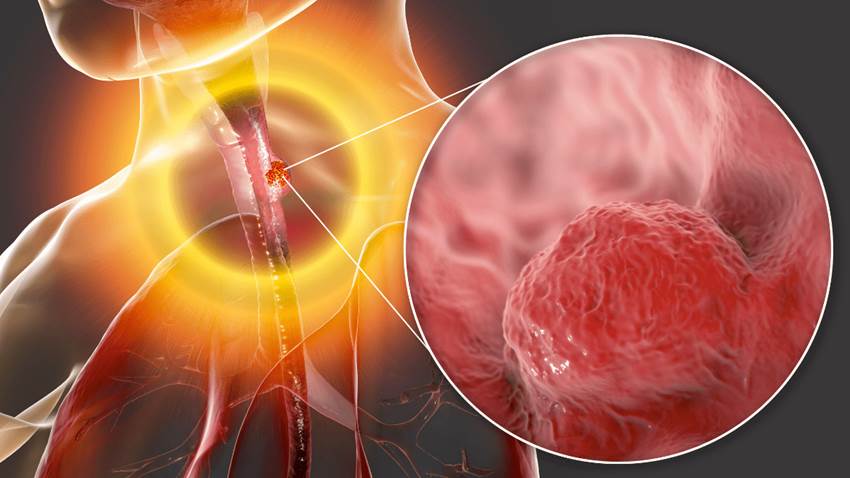 Importante seguimiento médico a largo plazo para pacientes con diagnóstico anterior de cáncer de esófago