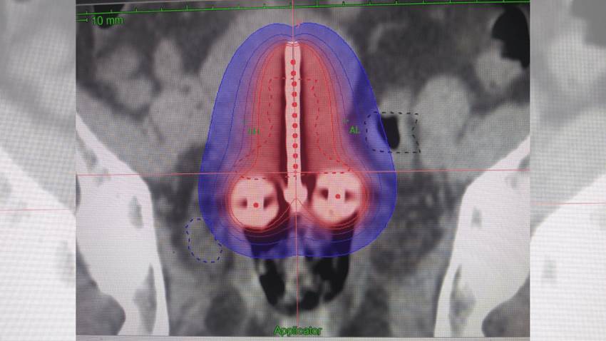 Prueba de VPH y la citología duplican posibilidad de detectar el cáncer cervical a tiempo, según estudio