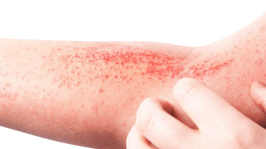 FDA aprobó abrocitinib para uso en adultos con Dermatitis Atópica de Moderada a Severa