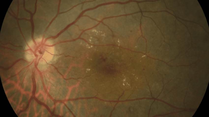 Conoce qué es el edema macular diabético y cómo prevenirlo