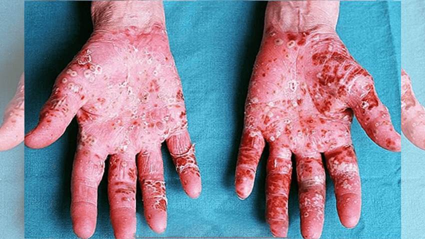 Estudio confirma falta de disposición de tratamientos eficaces a pacientes con algunos tipos de psoriasis
