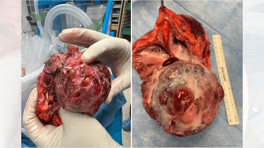 Salvan la vida de paciente con paraganglioma cardíaco en Puerto Rico