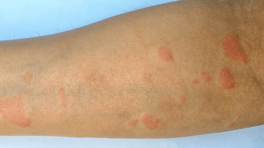 Estudio advierte sobre retraso diagnóstico en rara variante de lupus que provoca atrofia irreversible