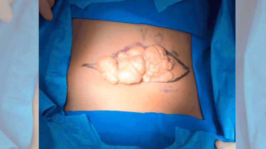 Tumor crece desmedidamente por siete años en paciente pediátrico puertorriqueño