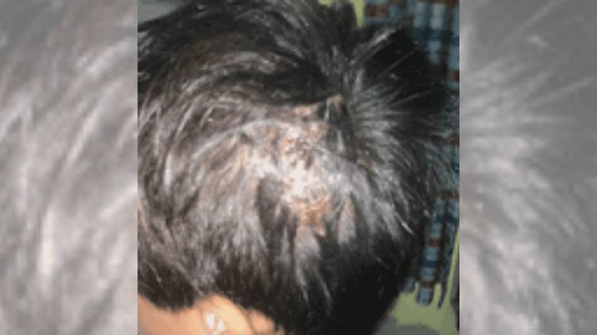 Dermatitis seborreica culmina con peligrosa infección de hongo en paciente pediátrico