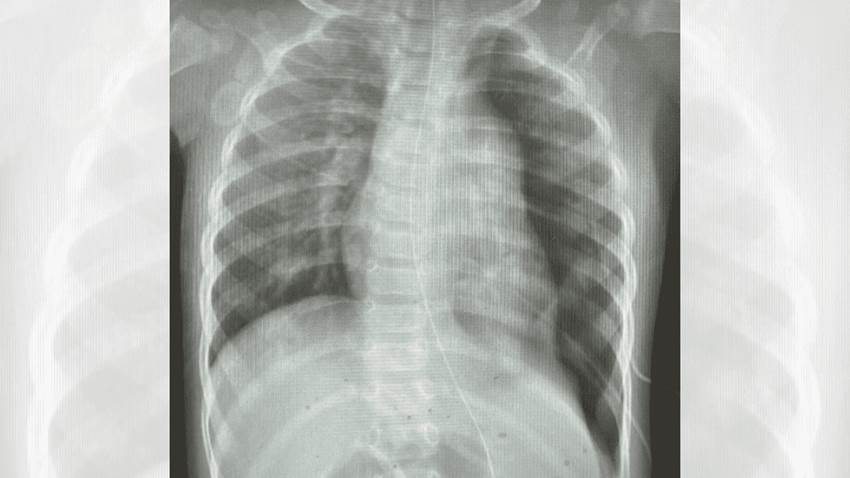 Médicos salvan la vida de infante con hernia diafragmática y estómago desplazado hacia los pulmones