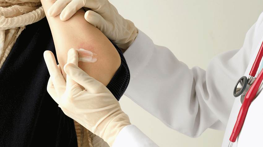Cinco cosas que se deben de saber en el tratamiento con biológicos en la psoriasis