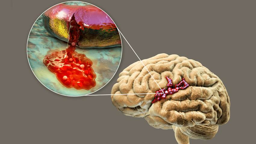 Algunos medicamentos contra la migraña producirían ictus en población envejeciente, según investigación