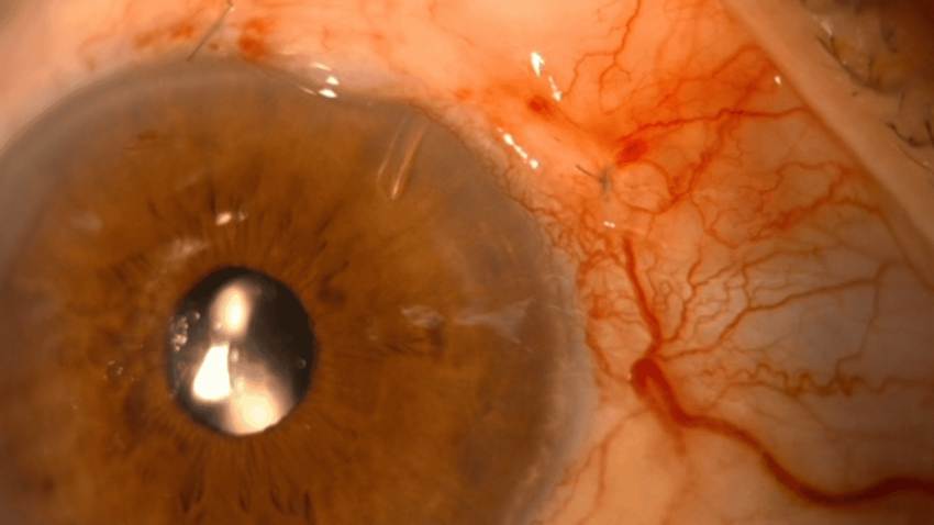 Colesterol “bueno” y glaucoma: Advierten de nuevo factor de riesgo en mayores de 55 años