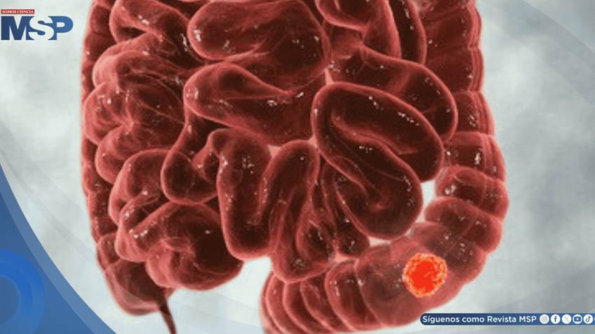 Síntomas digestivos que parecen colon irritable podrían ser cáncer colorrectal ¿Cómo diferenciarlos?