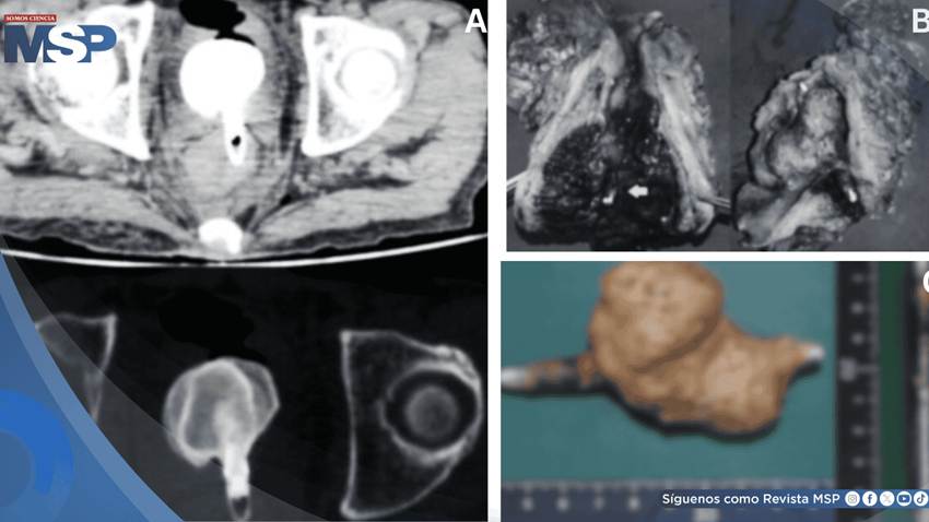 Cálculo vesical gigante adherido a cuerpo extraño rectal desencadenó sepsis fatal en paciente de 60 años