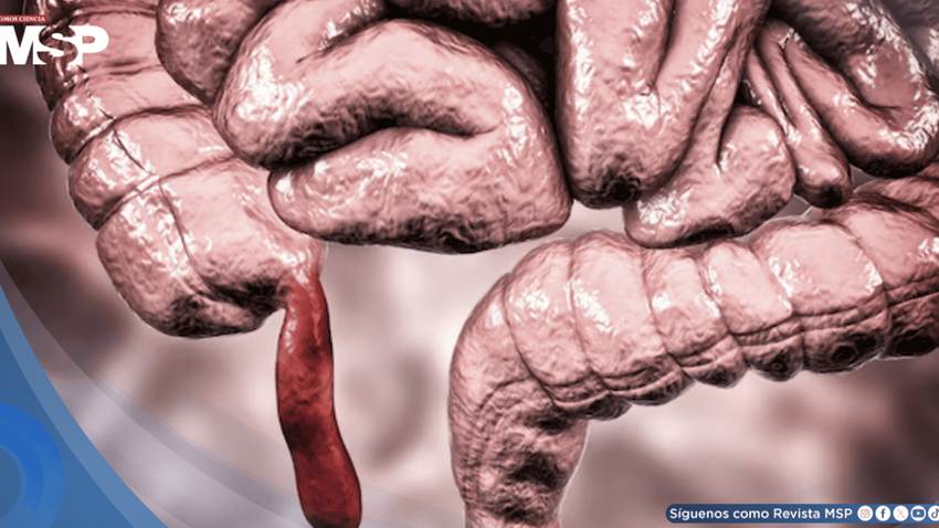 Dolor abdominal, náuseas y fiebre: ¿Cómo reconocer y tratar la apendicitis?