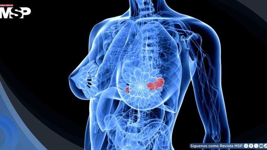 Así es como la nutrición podría reducir el riesgo de metástasis en el cáncer de mama