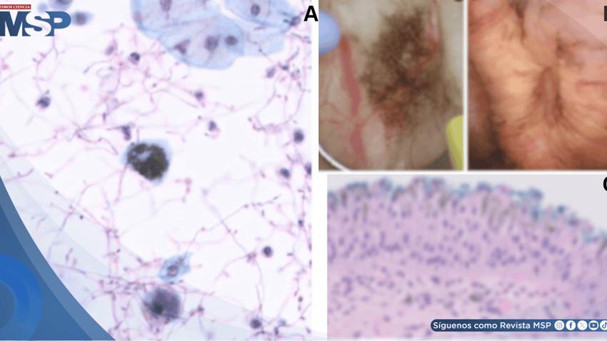 Hematuria indolora en adulto mayor revela cistitis por cándida y  hallazgo de pseudomelanosis vesical