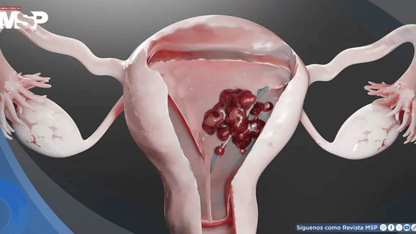 Coágulos del tamaño de una mano: Señal de alarma que confundieron con menstruación y ocultaba cáncer