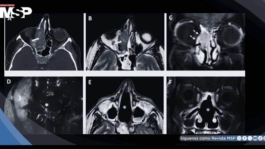 Necrosis cerebral asociada al consumo de cocaína tras cirugía de cáncer nasal