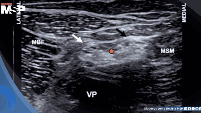 Picadura de escorpión en paciente pediátrico con dolor intenso es tratado con bloqueo ciático poplíteo