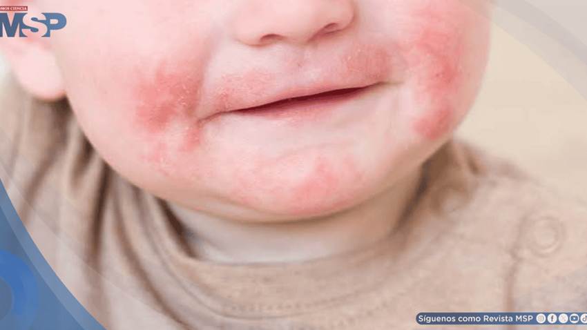 Dermatitis atópica, una enfermedad que necesita mayor visibilidad y más seguimiento de quienes la padecen