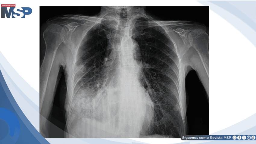Fiebre, tos y dificultad respiratoria: neumonía neumocócica en adulto mayor con comorbilidades