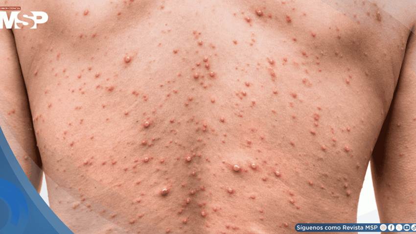 Viruela del mono: Argentina confirma 15 casos de mpox en lo que va de 2026