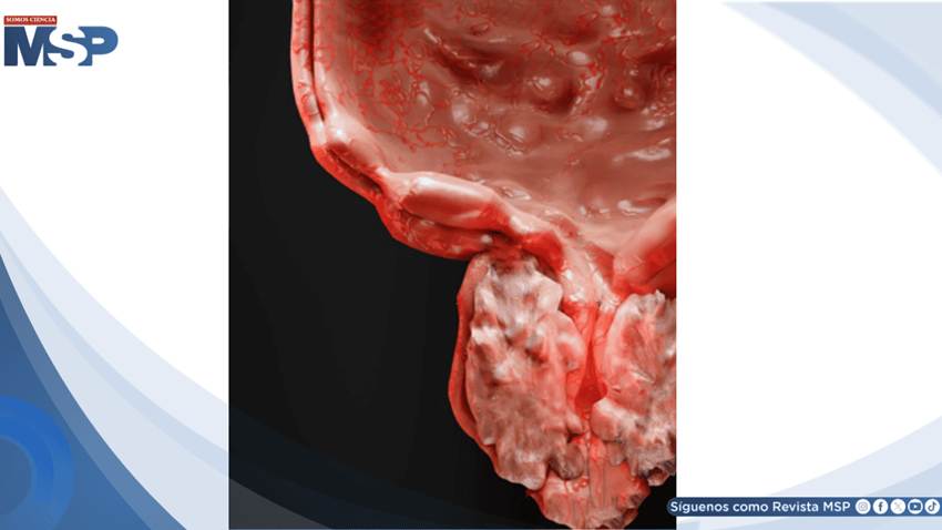 Carcinoma renal con trombo tumoral: una presentación compleja documentada en Puerto Rico