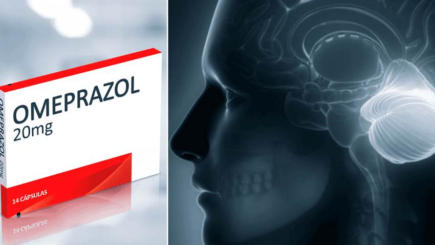 Déficit de magnesio asociado al consumo prolongado de Omeprazol podría desencadenar síndrome cerebeloso