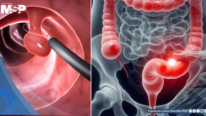¿Sangrado rectal? Podría ser señal temprana de cáncer colorrectal en adultos jóvenes