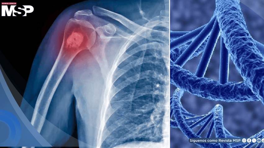 Identifican un nuevo gen que eleva el riesgo de osteosarcoma, el cáncer óseo más común en niños