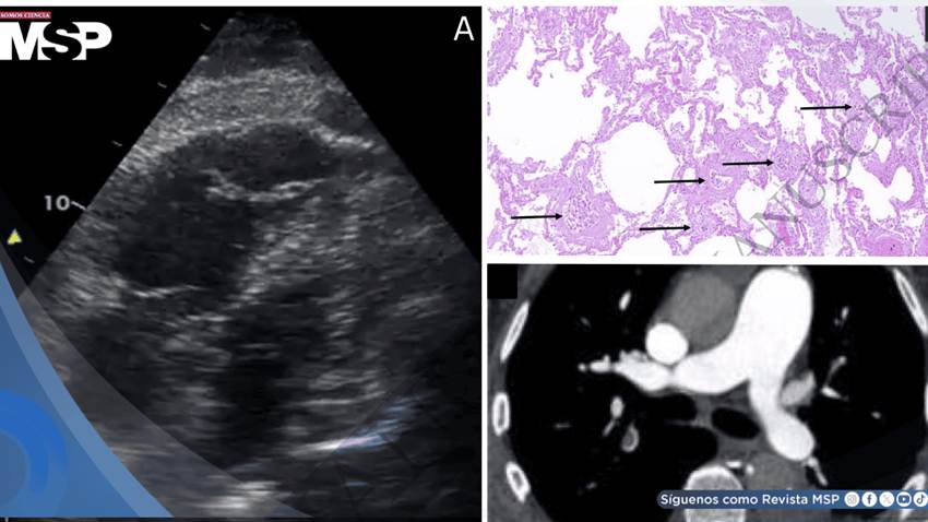 Shock obstructivo agudo por microangiopatía trombótica tumoral pulmonar en paciente con estenosis aórtica