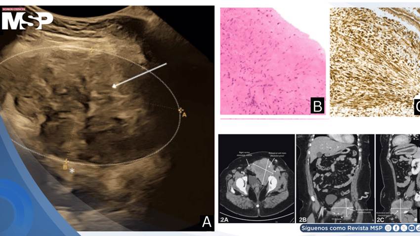 Tumor desmoide abdominal de compresión ilíaca durante el embarazo causa trombosis venosa profunda crónica