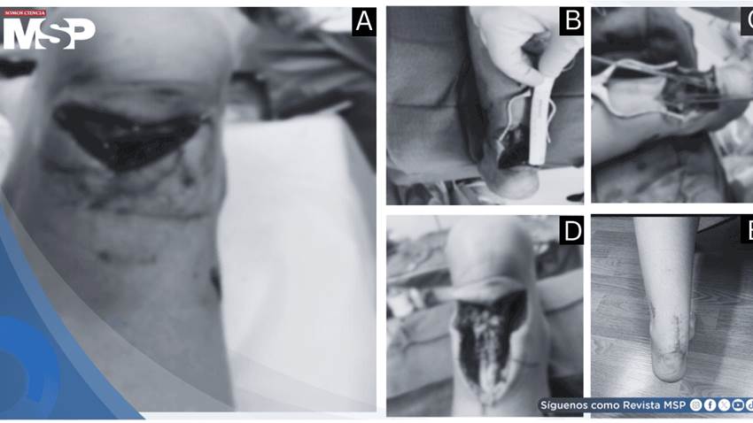 Rotura traumática distal del tendón de Aquiles en paciente de 10 años y reparación quirúrgica Krackow