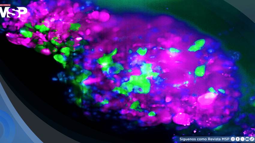 Así se detecta el cáncer en estadio 0: Ofrece supervivencia del 99 % si se diagnostica a tiempo