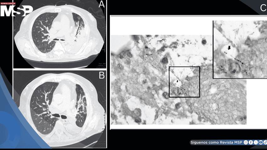 Detectan nocardiosis pulmonar como causa de neumonía severa refractaria en paciente con EPOC