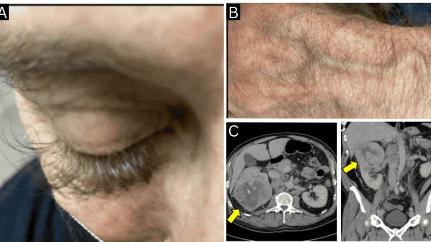 Crecimiento anormal de pestañas como señal inicial de un carcinoma renal metastásico