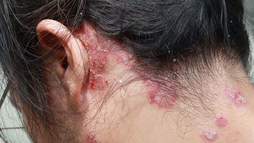 La psoriasis se asocia con un aumento del riesgo de tromboembolismo venoso y enfermedad vascular