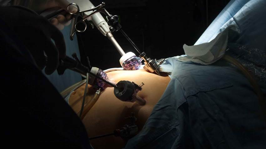 La cirugía bariátrica es el mejor tratamiento para la esteatosis hepática, según estudio