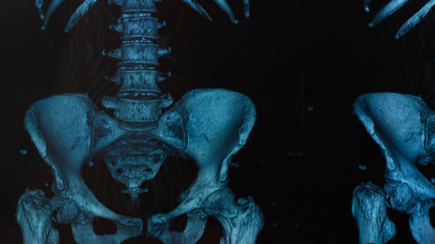 Hombre de 59 años con tos y orina espumosa es diagnosticado con mieloma múltiple